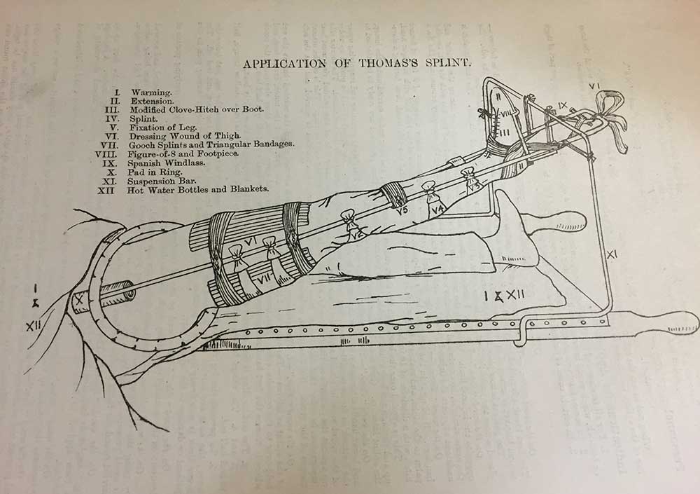 Image of an illustration of the Thomas splint in use