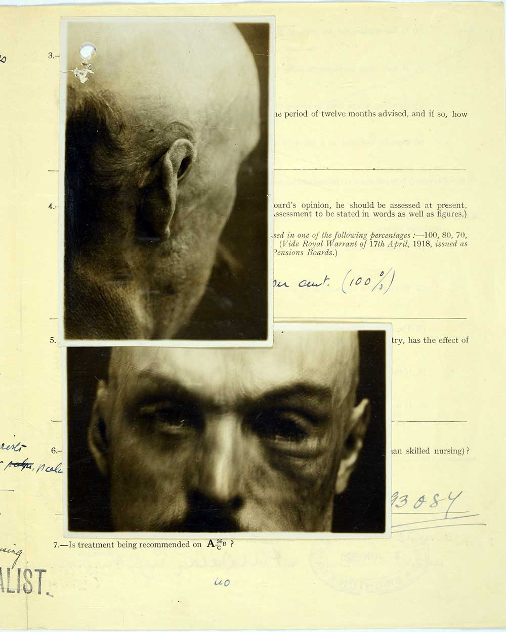 Image depicts the burn face and head of Rowland.